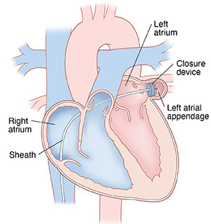 Cross section of heart showing catheter inserted through inferior vena cava and across both atria into left atrial appendage. Closure device is at end of catheter in left atrial appendage.