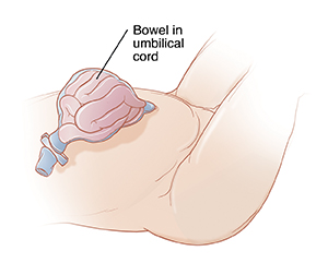 Baby's abdomen showing bowel inside umbilical cord.