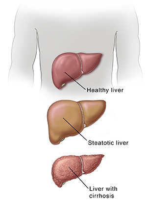 Healthy liver, steatotic liver, liver with cirrhosis.
