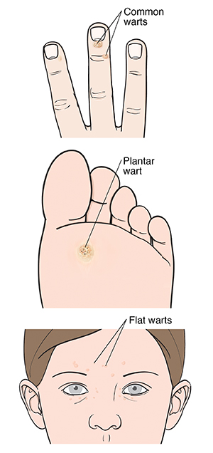 Warts on light skin: Common warts on end of finger, plantar wart on sole of foot, and flat warts on face.