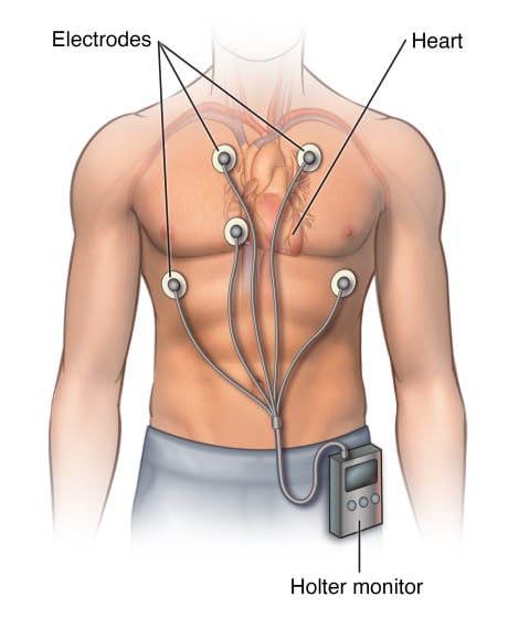 Man's torso showing five ECG leads attached to chest and connected to Holter monitor clipped to belt.