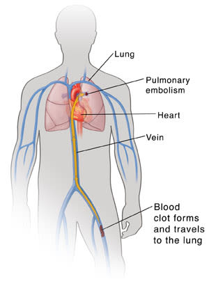 Outline of male torso showing heart, lungs, and major veins. Blood clot is in leg vein with arrow showing it traveling up vein to lung.