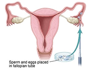 Front view cross section of female reproductive tract showing instrument injecting sperm and eggs into fallopian tube.