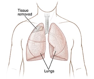 Front view of chest showing lungs and area of lung to be removed.