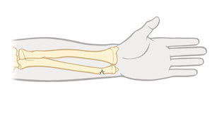 Lower arm bones, showing greenstick fracture of bone at wrist on little finger side.