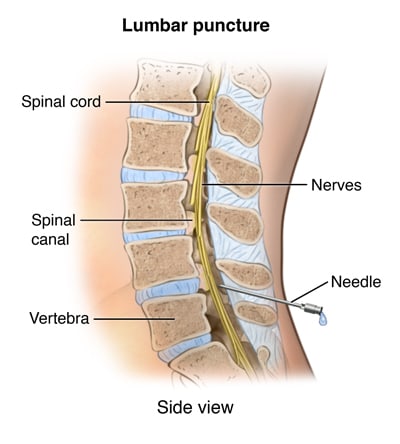 Lumbar puncture with needle inserted in spine