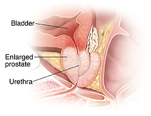 Cross section of enlarged prostate gland, bladder, and urethra..