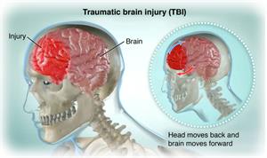 Two side-by-side illustrations of a human head in cross-section showing brain and skull showing how the brain shifts inside the skull during a traumatic impact.
