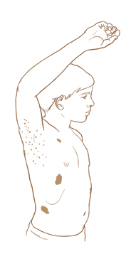 Teen boy with small brown spots in armpit and large brown spots on chest and abdomen.