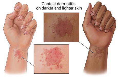 Contact dermatitis on fingers and wrist, with close-ups showing a purplish rash on darker skin and a reddish rash on lighter skin.