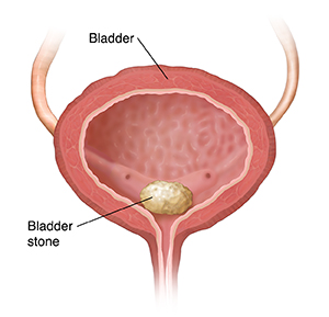 Cross section of bladder showing bladder stone at opening to urethra.