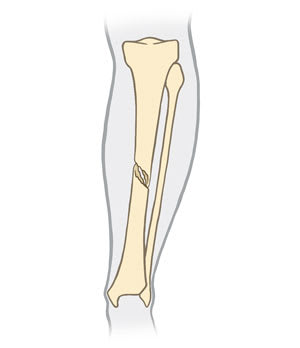 Shin bone with spiral break.