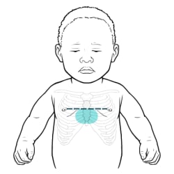 Baby’s front torso with area on breastbone just below nipple line highlighted.