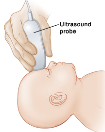 Ultrasound of the baby’s head is used to detect and monitor IVH. Baby's head with hand holding ultrasound probe over forehead.