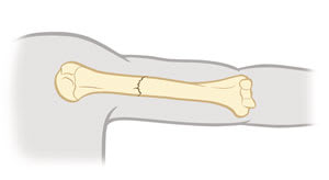 Non-displaced fracture of upper arm bone, showing no gap at break.