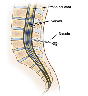 Cross section of lumbar spine showing needle inserted into epidural space.