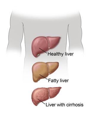 Healthy liver, steatotic liver, liver with cirrhosis