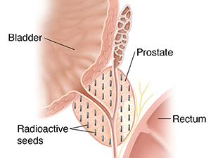 Cross section of prostate showing radioactive seeds for interstitial brachytherapy.