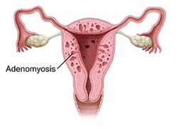 Front view cross section of uterus showing adenomyosis.