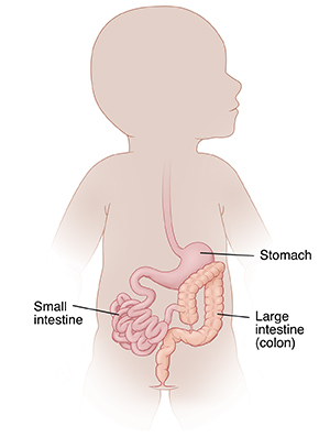Outline of infant showing intestinal malrotation of digestive tract.