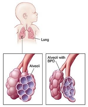 Lungs in newborn's chest, with detail of normal alveoli and of alveoli showing bronchopulmonary dysplasia (BPD).