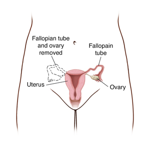 Female pelvis showing reproductive organs. Dotted lines show removal of Fallopian tube and ovary on one side.