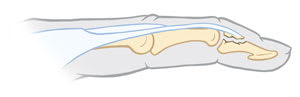 Avulsion fracture in finger, showing piece of fingertip bone pulled off by tendon.