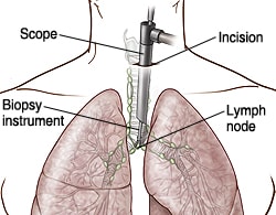Front view of chest showing incision, scope in the chest, and lungs and lymph nodes.
