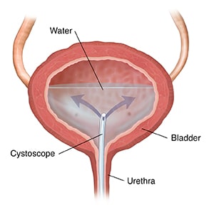 Cross section of bladder, showing catheter inserted through ureter, releasing water into bladder.