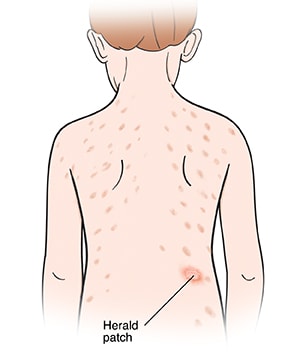 Rash on child's back with one large spot of herald patch.