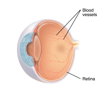 Cross section three-quarter view of eye, showing normal blood vessels on retina.