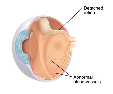Cross section three-quarter view of eye, showing retinopathy of prematurity. 