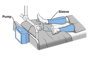 Patient in hospital bed wearing intermittent compression sleeves on legs.