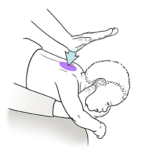 Primer plano de un adulto sosteniendo al bebé boca abajo en el regazo, preparándose para golpear entre las escápulas con el talón de la mano.