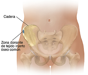 Vista frontal de la parte inferior del abdomen femenino donde se muestran los huesos pélvicos. El área en azul muestra la posible zona donante de tejido óseo para injerto.