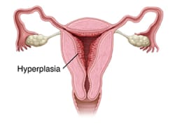 Front view cross section of female reproductive organs showing endometrial hyperplasia.